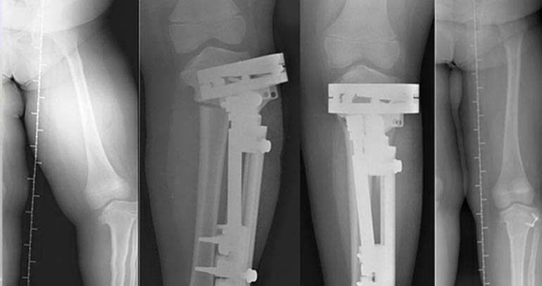 Deformity Correction Treatment In Coimbatore