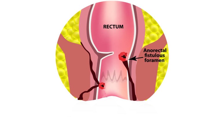 Fistula Surgery In Coimbatore