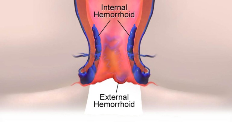Hemorrhoid Treatment In Coimbatore