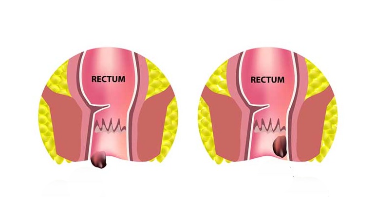 Hemorrhoid Treatment In Coimbatore