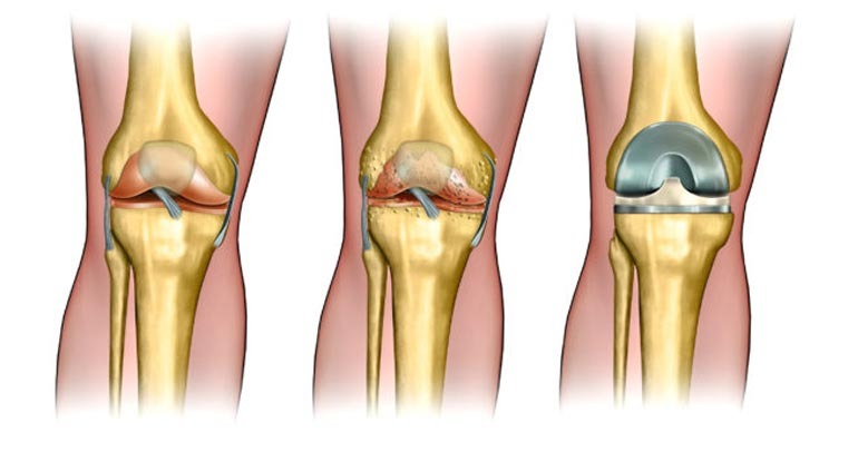 Joint Replacement Treatment In Coimbatore