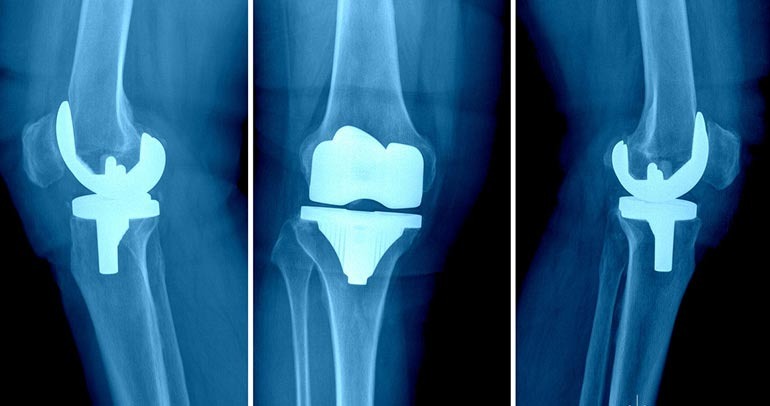 Joint Replacement In Coimbatore