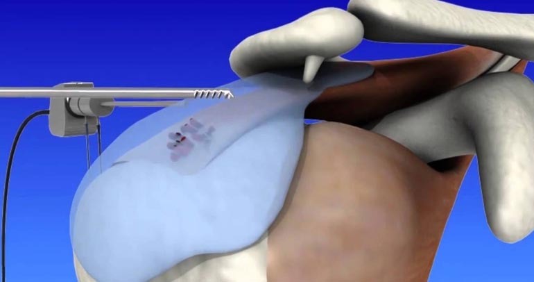 Arthroscopic Surgery In Coimbatore