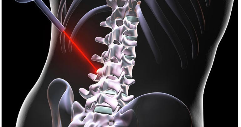 Spine Surgery In Coimbatore